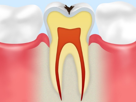 C1：エナメル質に穴を空けた虫歯