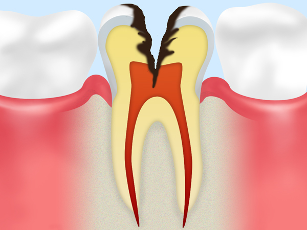 C3：歯髄に達した虫歯
