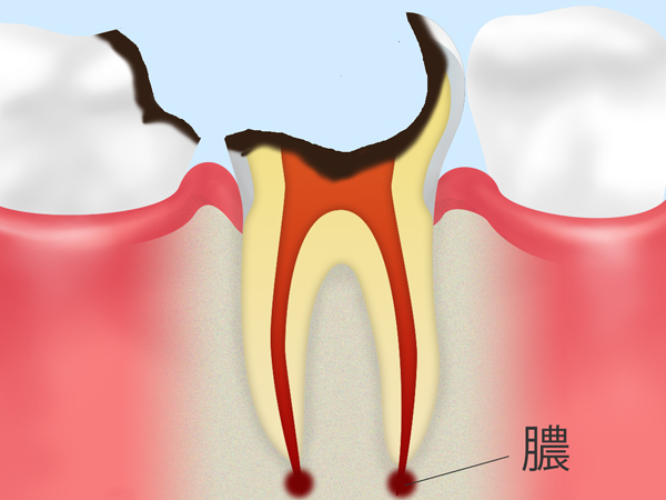 C4：歯の根に達した虫歯