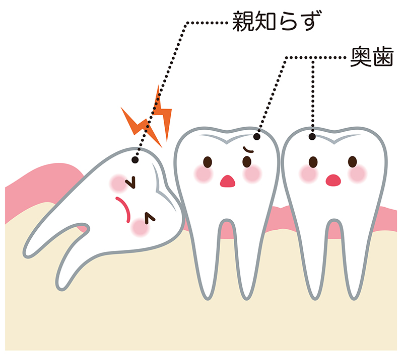 親知らずを抜いたほうがいい場合