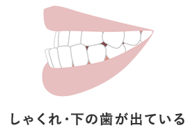 しゃくれ・下の歯が出ている