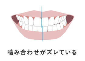 噛み合わせがズレている