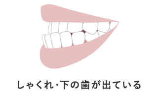 しゃくれ・下の歯が出ている